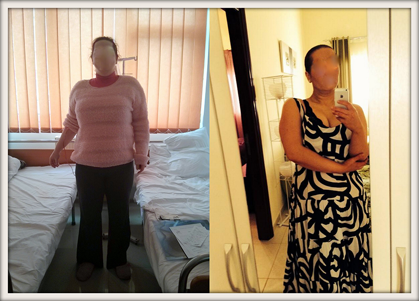 EM, 35 ani, gastric sleeve, 103 kg, 82 kg – 21 kg in 5 luni