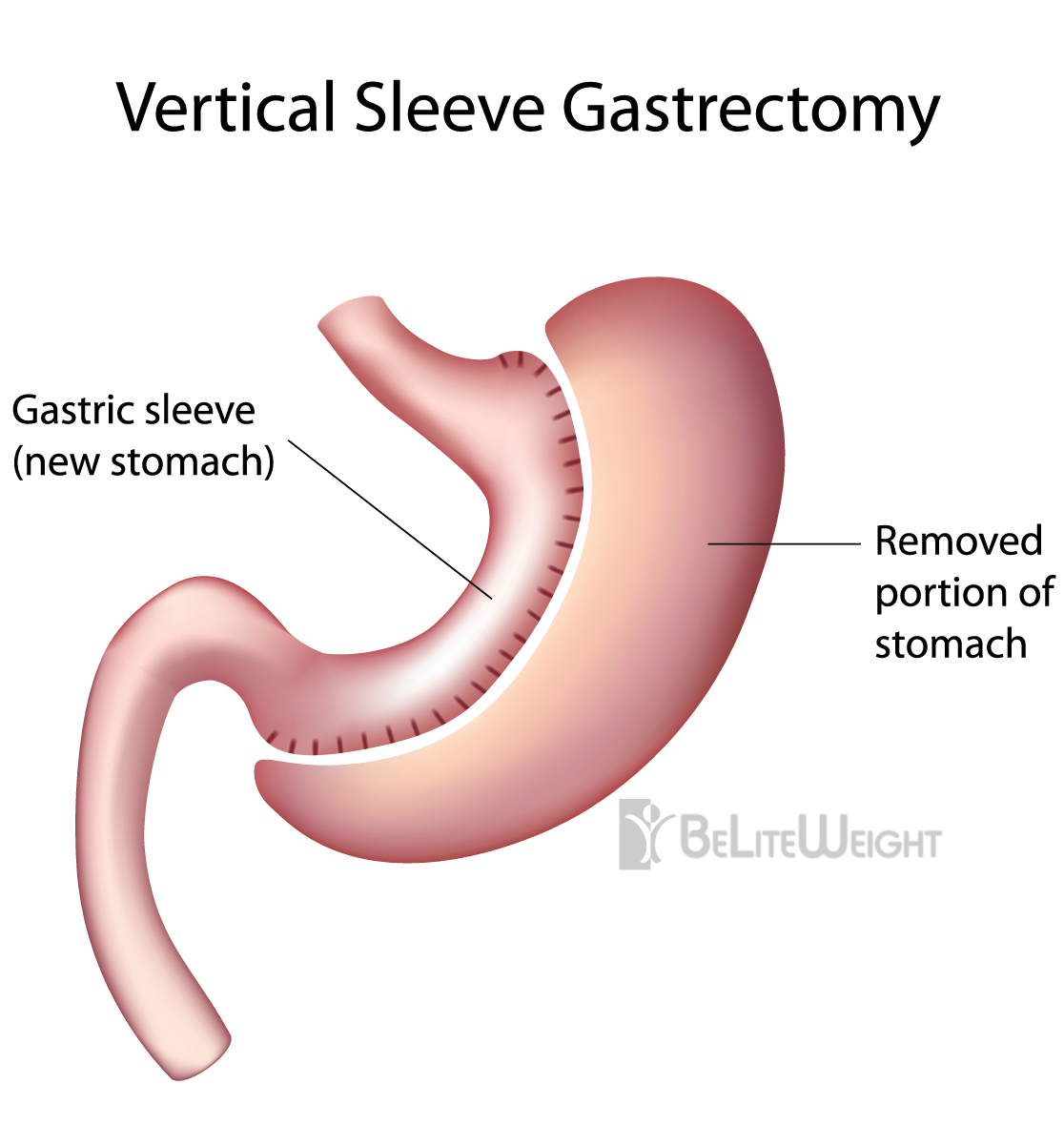 Gastric-Sleeve-Vertical-Sleeve-Gastrectomy